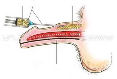 ការពង្រីកលិង្គនៃការចាក់បញ្ចូល